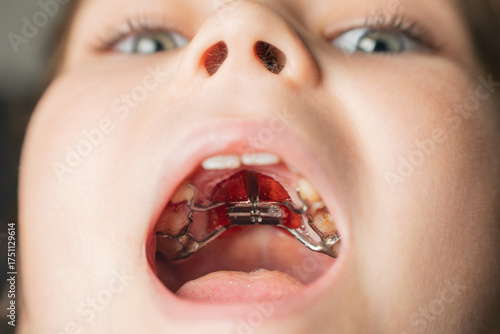 Palatal expander dental device in mouth. Medical and orthodontic equipment inside oral cavity