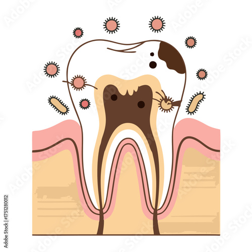 Detailed Illustration of a Decayed Tooth Showing Caries and Infection with Bacteria.