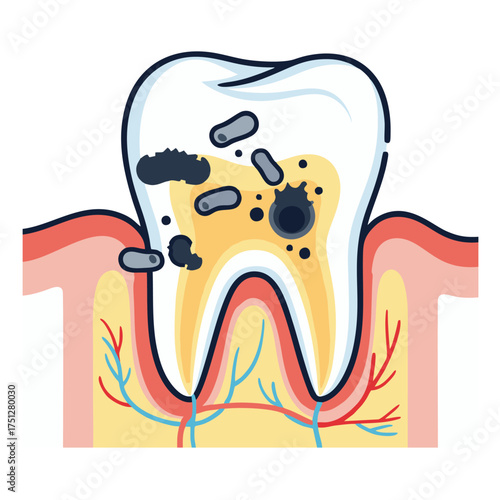 Diseased Tooth with Bacteria and Decay, Illustrating Dental Problems.