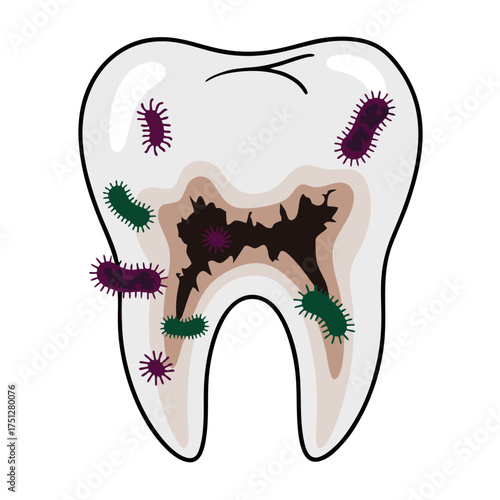Diseased Tooth with Cavities and Microscopic Bacteria Illustration.