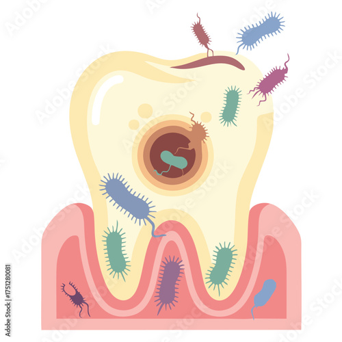 Diseased Tooth with Cavity and Numerous Bacteria Infestation.