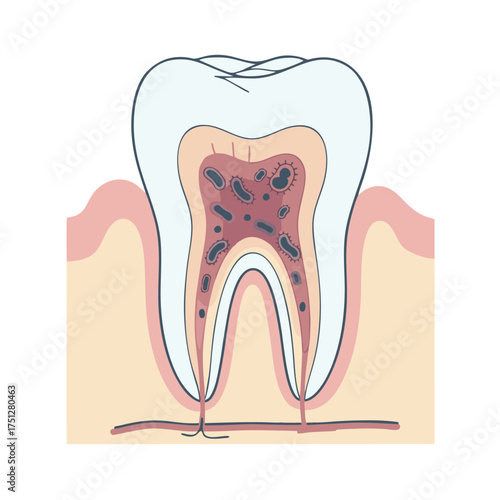 Tooth Cross-Section Illustration with Decay, Showing Enamel, Dentin, Pulp, and Root.