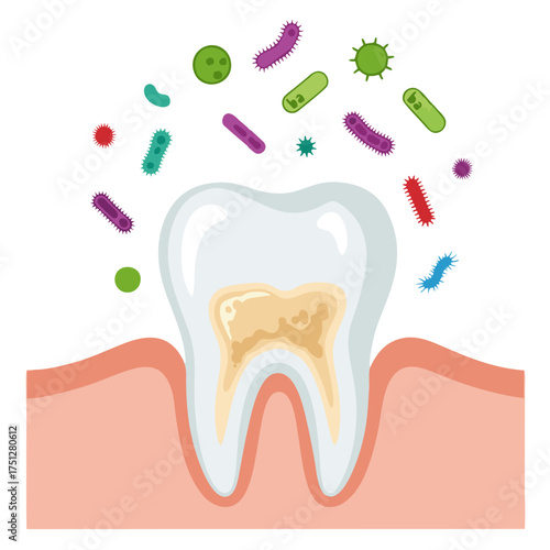 A cartoon illustration of a molar tooth with yellow decay, surrounded by colorful, floating bacteria and germs.