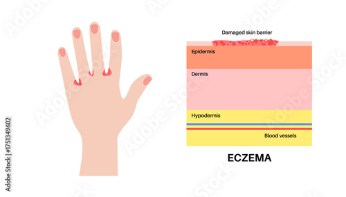 Dermatitis skin disease