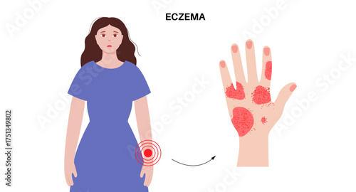 Dermatitis skin disease