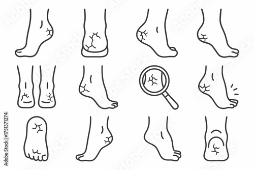 Foot and heel care: recognizing cracked skin issues and solutions