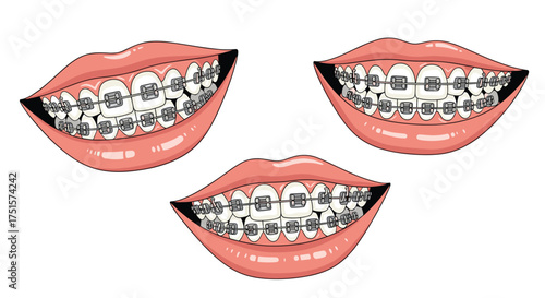 Close up of three mouths showing perfectly aligned teeth with metal braces applied for dental correction.