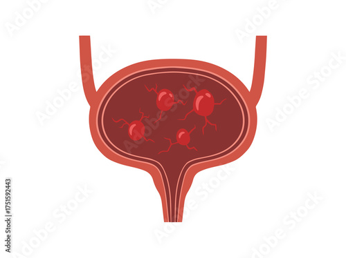 Bladder Polyps Clip Art Illustration