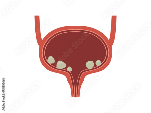 Bladder Stones Clip Art Illustration