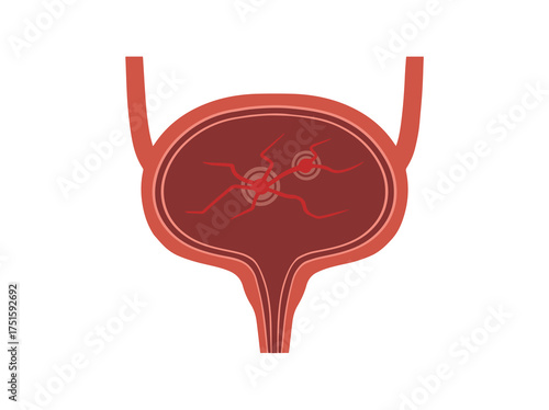 Bladder Cystitis Clip Art Illustration