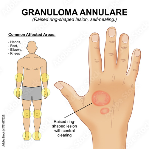 Granuloma annulare, Skin flashcard medical illustration