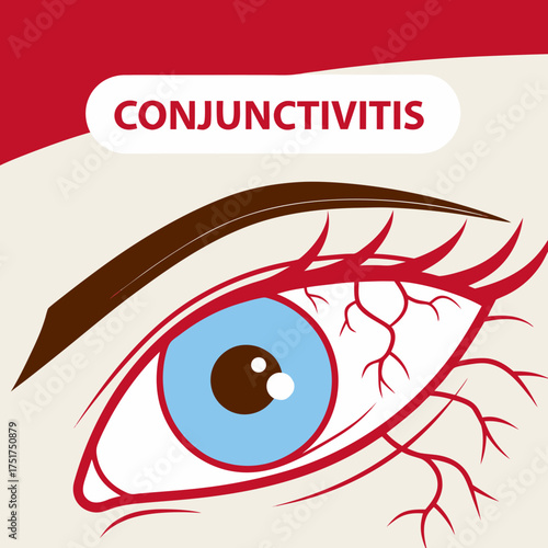 Relatable conjunctivitis illustration, eye infection, eye redness, pink eye awareness, health concept, medical illustration, eye health, red veins