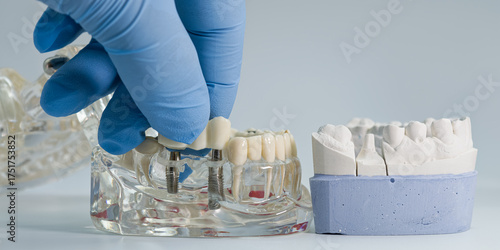 Placing dental implant bridge on transparent jaw model