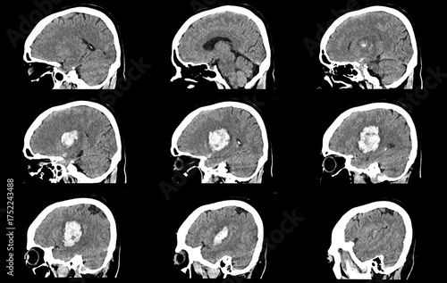 CT scan brain image showing intracerebral hemorrhage stroke