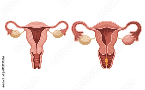 Comparison of a healthy uterus and ovaries versus a uterus with fibroids