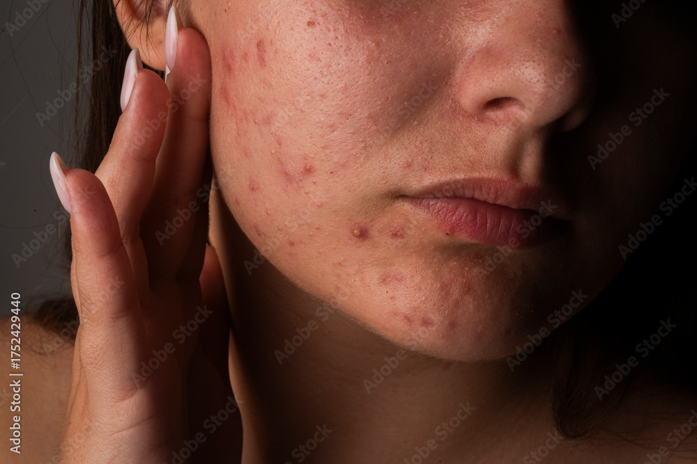Naklejka premium Many pimples. Girl with bad skin. Hormonal acne. Skin acne background. Closeup acne pimple. Treatment for acne skin. Problem skincare. Pimples, pores, scars. Skincare treatment.