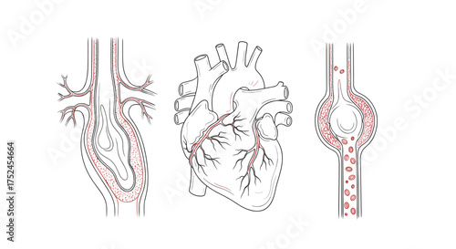 Illustration showing human heart and blood vessels with aneurysms