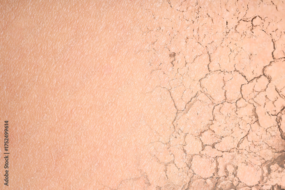 Fototapeta premium Dry skin presented as double exposure with cracked soil