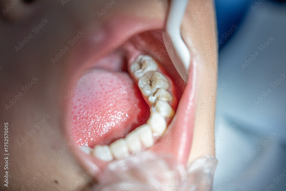 Obraz premium Young dentist healing little boy patient's teeth,Prevention of diseases of baby teeth in child
