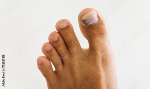 On the big toe, traces of blue discoloration are visible under the nail. Close-up. A man's foot with a sore and blue toe in a home setting. Concept of podiatry and health.