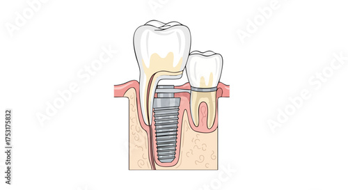 Dental implant illustration showcasing the process of tooth replacement for oral health and dental care with nearby tooth