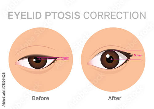 Illustration of eyelid ptosis correction showing before and after transformation.Upper blepharoplasty.Perfect for beauty and medical content.