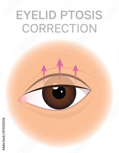 Eyelid Ptosis Correction Concept Illustration.Upper blepharoplasty. Can be used for beauty and medical content.