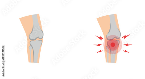 Knee pain anatomy with inflammation highlighted in medical diagram