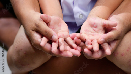 Hand, foot and mouth disease HFMD Human hand of scarlet fever in coxsackievirus palmarosa virus and child hand on white background