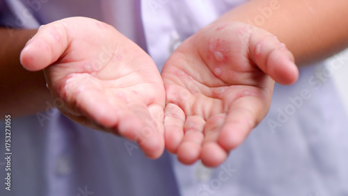 Hand, foot and mouth disease HFMD Human hand of scarlet fever in coxsackievirus palmarosa virus and child hand on white background