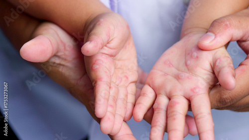Hand, foot and mouth disease HFMD Human hand of scarlet fever in coxsackievirus palmarosa virus and child hand on white background