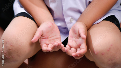 Hand, foot and mouth disease HFMD Human hand of scarlet fever in coxsackievirus palmarosa virus and child hand on white background