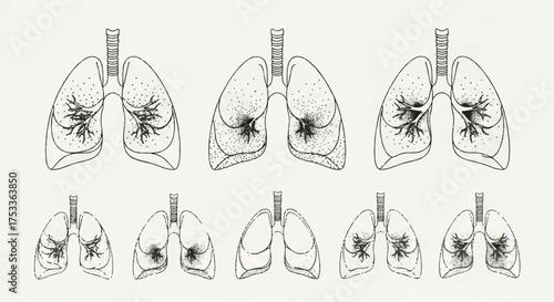 Illustration of human lungs with various types of tumors, showcasing different stages and locations of cancer growth in a medical educational style with a neutral color palette on a plain