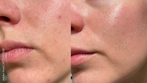 Macro close-up of female face showing before and after skincare results with visible pores, acne, and redness transforming into smooth glowing healthy skin. Perfect for beauty and dermatology themes.