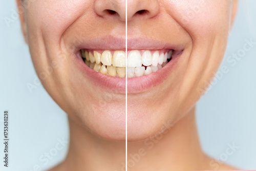 Young woman before and after teeth whitening close-up. Half-smile comparison showing stained teeth versus bright white teeth. Dental care, oral hygiene, healthy smile concept