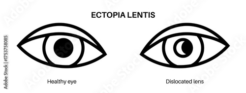 Ectopia lentis disease