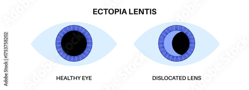 Ectopia lentis disease