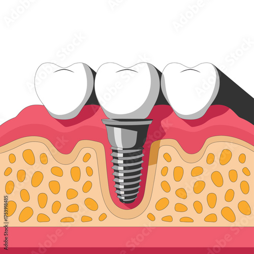 Dental implant teeth gum anatomy healthy mouth dentistry restoration oral health procedure