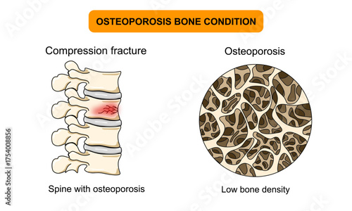 Illustration of osteoporosis bone condition, low bone density, spinal compression fracture, back pain,. Vector for medical, clinical, or educational posters.