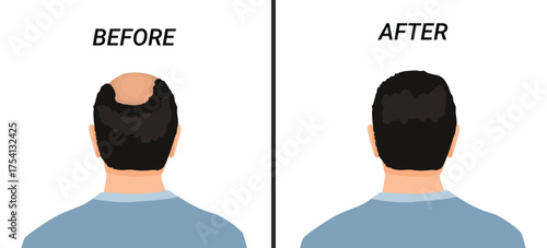 Back view male head before and after hair transplant or hair loss treatment