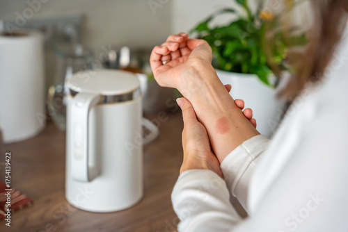 Scald burn on a hand caused by steam from a kettle in a kitchen. Domestic accident illustrating the danger of hot appliances.