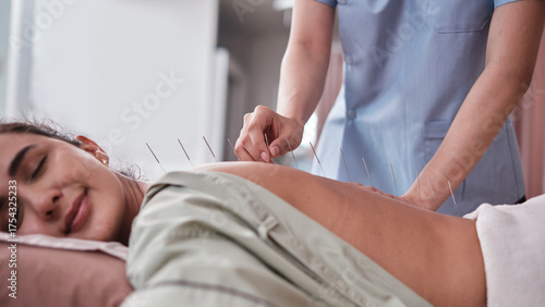 Close-up shot of physiotherapist's hand, acupuncture treatment to Latin woman patient, healing muscle and back pain relief, Asian passive medical therapy at healthcare wellness spa in hospital clinic.