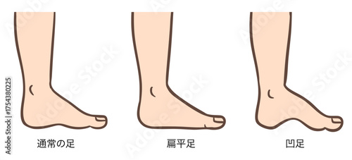 足の変形、正常な足、扁平足、凹足のイラストセット01
