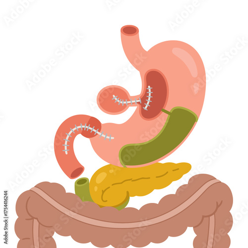 Gastric bypass surgery diagram showcasing weight loss procedure and digestive system changes, medical illustration for health and educational resources