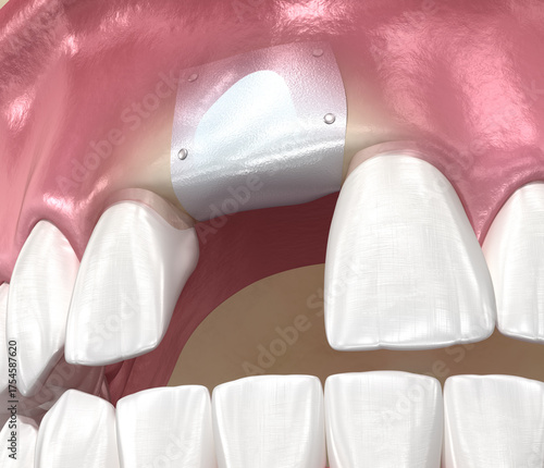 Bone grafting augmentation, socket preservation, tooth implantation. Medically accurate 3D illustration.