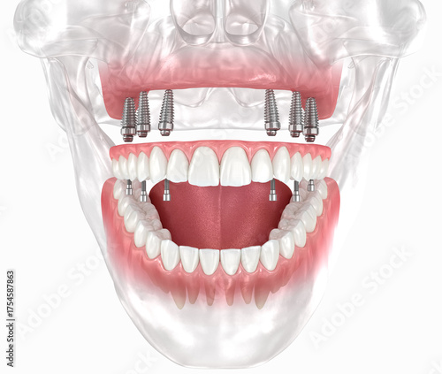 Maxillary prosthesis with gum All on 6 system supported by implants. Dental 3D illustration