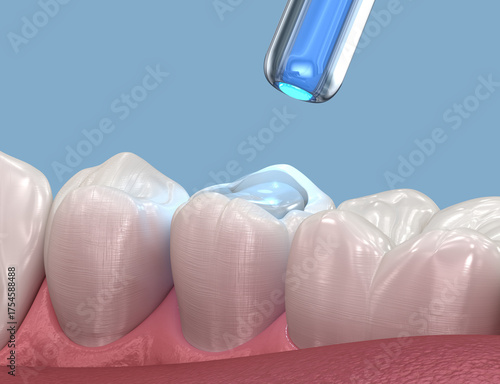Tooth restoration with filling and polymerization lamp. Dental 3D illustration