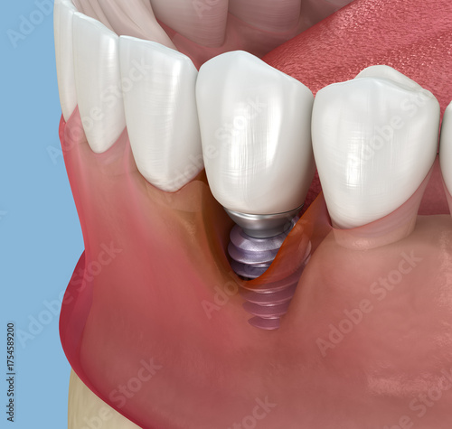 Peri-implantitis with visible gingiva recession. Medically accurate 3D illustration.