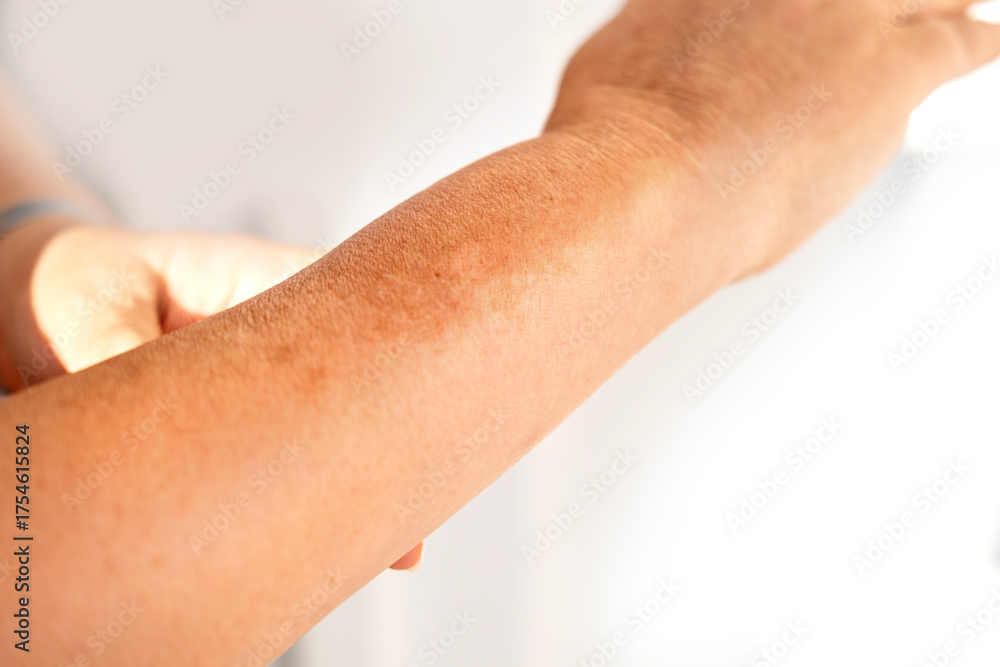 Fototapeta premium Close-up mature woman’s hand with age spots and pigmentation, showing signs of melanin overproduction, aging skin, and natural changes, skincare and health concept, hyperpigmentation