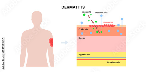 Dermatitis skin disease